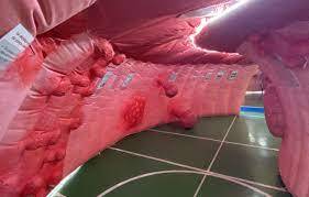 Interieur du colon 