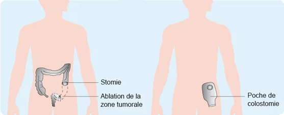 cancer colorectal